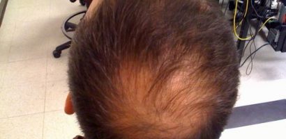 Hair Loss Being The Most Common Physiological Problem In Men
