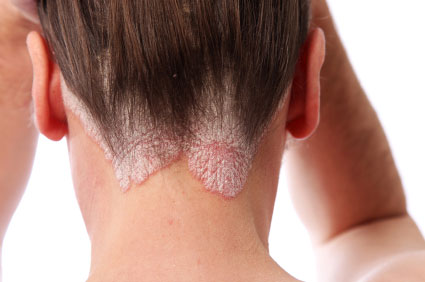 psoriasis treatment in islamabad)