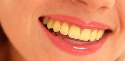 Yellow Teeth Whitening Tips in Urdu Treatment Home Remedy